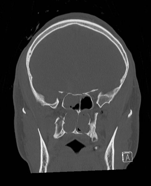 File:Base of skull fracture with bilateral Le Fort fractures (Radiopaedia 47094-51638 Coronal bone window 64).jpg