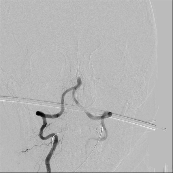 File:Basilar artery thrombosis treated with intra-arterial urokinase (Radiopaedia 34571-35949 A 16).png