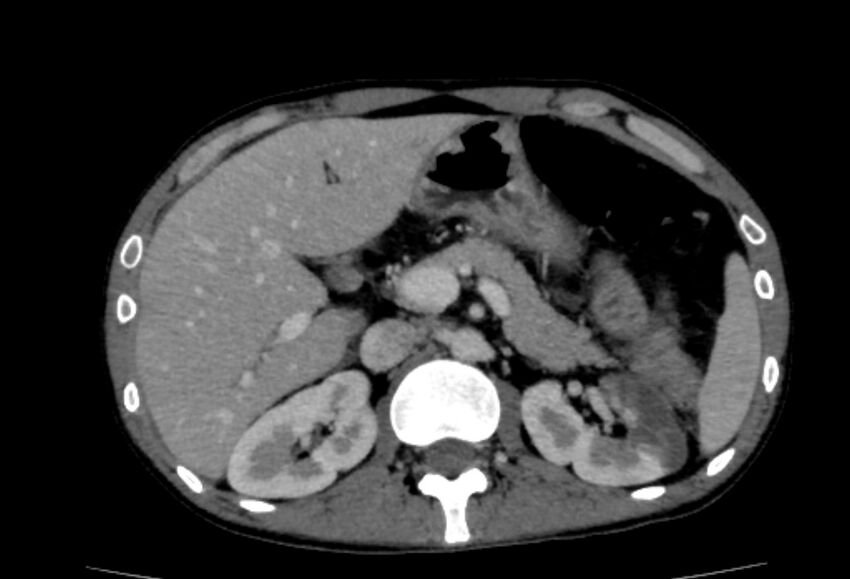Behçet's disease- abdominal vasculitis (Radiopaedia 55955-62570 A 22).jpg