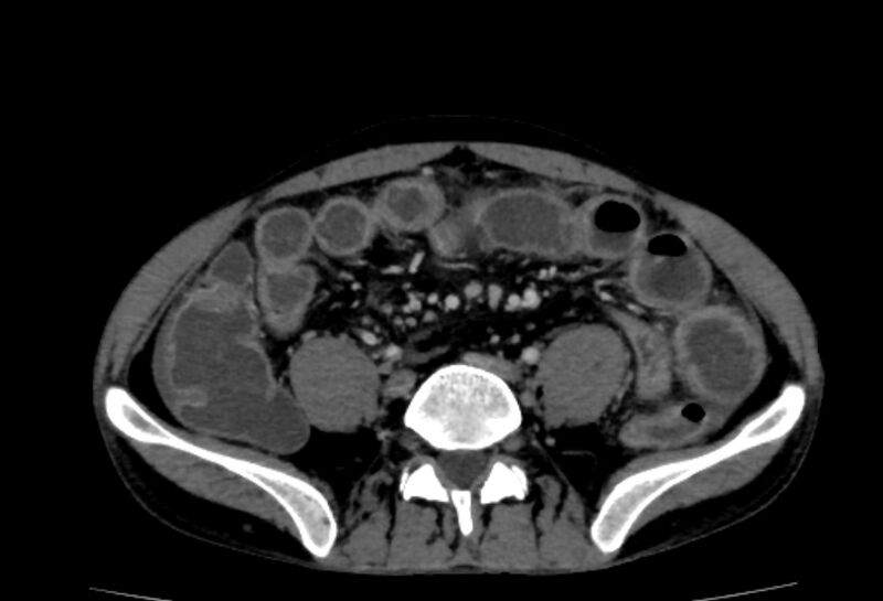 File:Behçet's disease- abdominal vasculitis (Radiopaedia 55955-62570 A 58).jpg