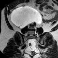 Benign seromucinous cystadenoma of the ovary (Radiopaedia 71065-81300 F 21).jpg