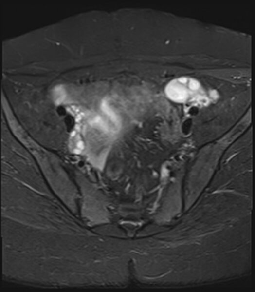 File:Bicornuate, unicollis uterus (Radiopaedia 79468-92593 Axial STIR 5).jpg