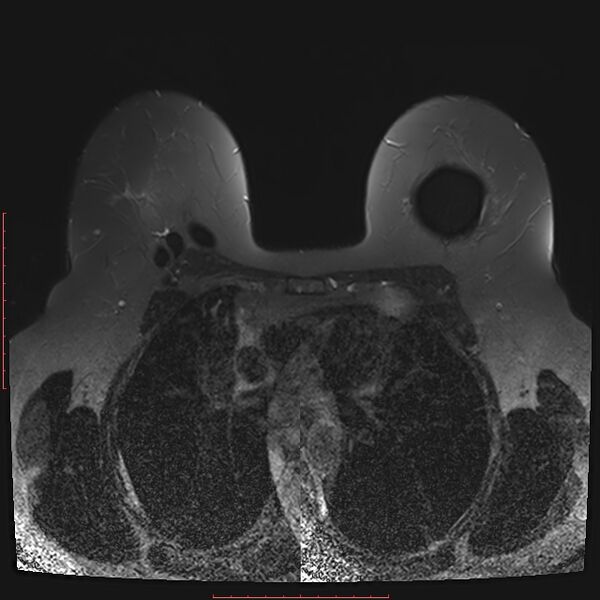 File:Bilateral breast implant rupture (Radiopaedia 24761-25027 T2 fat sat 14).jpg