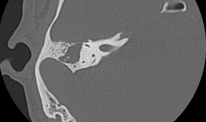 File:Bilateral cholesteatoma (Radiopaedia 54898-61172 Axial bone window 32).jpg