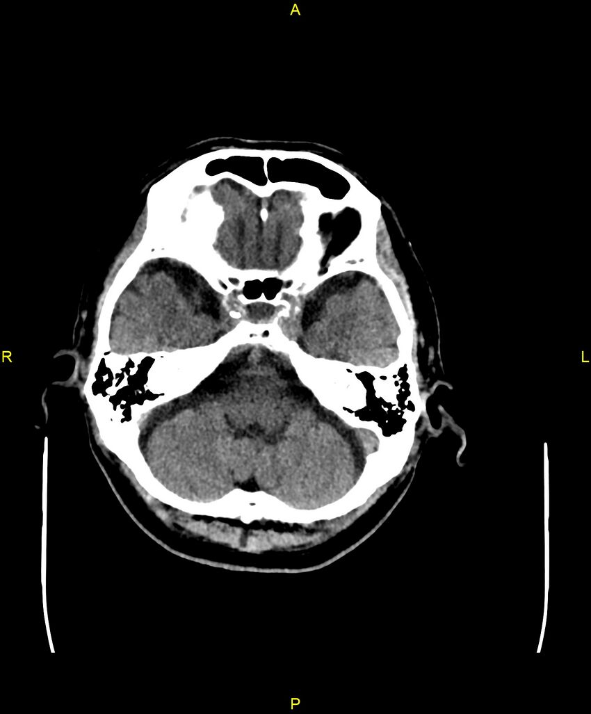 Bilateral isodense subdural hematomas (Radiopaedia 88621-105325 Axial non-contrast 23).jpg