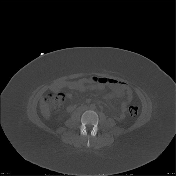 File:Bilateral lumbar ribs (Radiopaedia 25862-26010 bone window 26).jpg