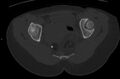 Bilateral mature cystic ovarian teratoma (Radiopaedia 88821-105592 Axial bone window 32).jpg