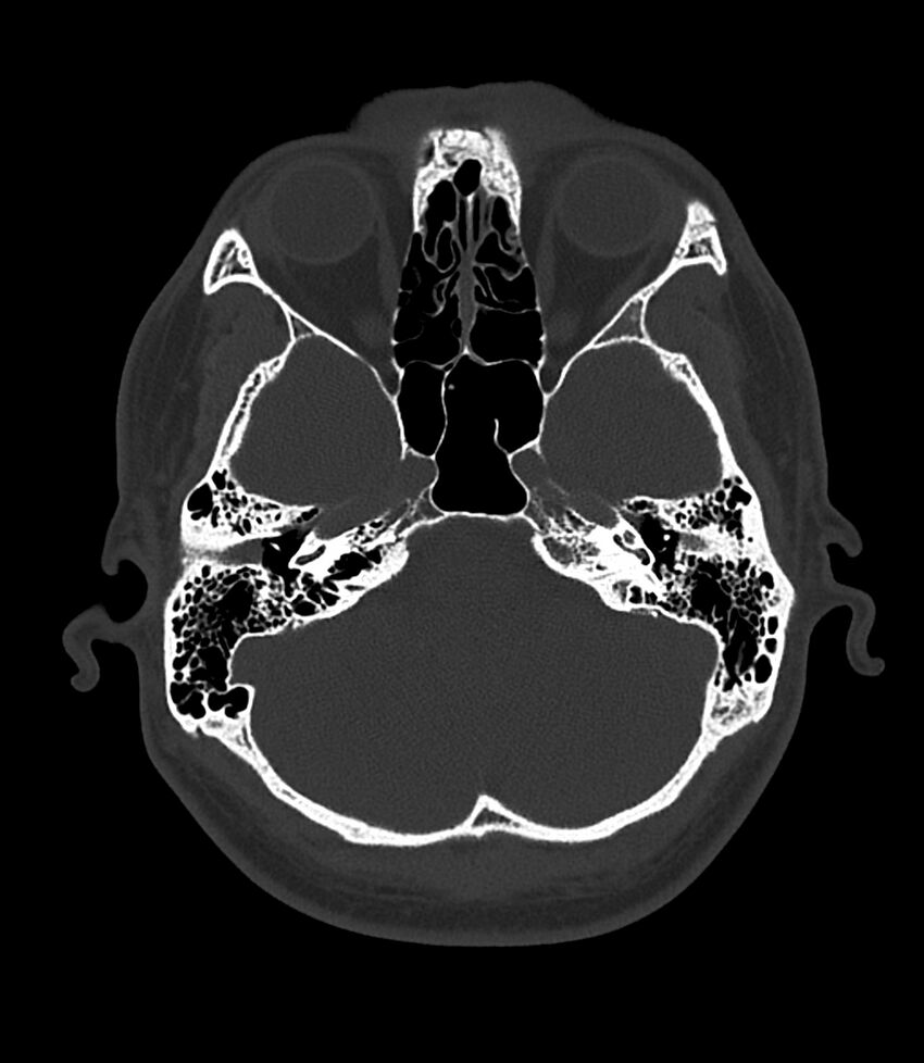 Bilateral medial canal fibrosis (Radiopaedia 85598-101344 Axial bone window 37).jpg