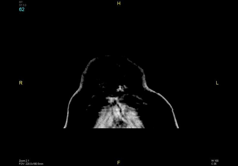 File:Bilateral medial medullary infarction (Radiopaedia 42220-45295 Coronal non-contrast 62).jpg