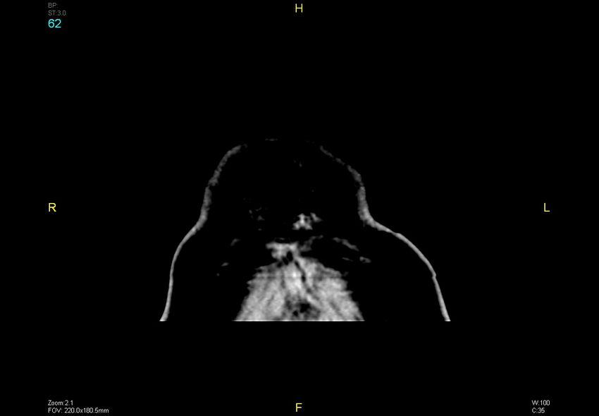 Bilateral medial medullary infarction (Radiopaedia 42220-45295 Coronal non-contrast 62).jpg
