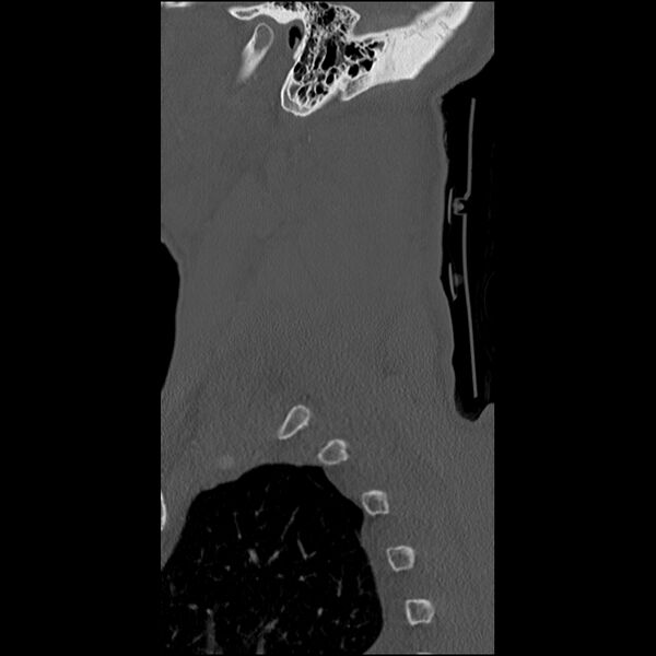 File:Bilateral perched facets with cord injury (Radiopaedia 45587-49713 Sagittal bone window 52).jpg