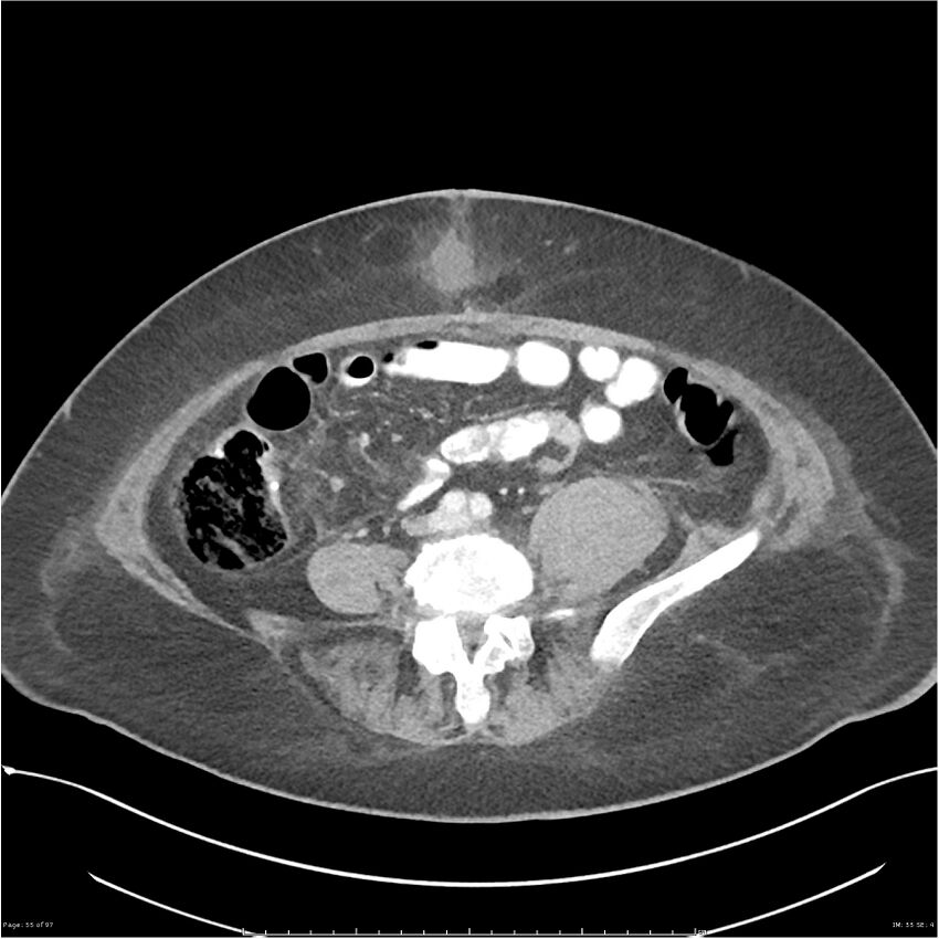 Bilateral psoas hematomas (Radiopaedia 24057-24279 A 55).jpg