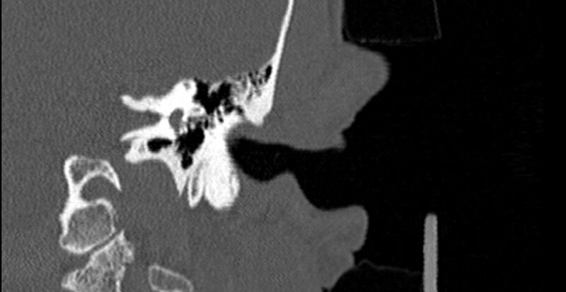 File:Bilateral temporal bone fractures (Radiopaedia 29482-29970 B 41).jpg