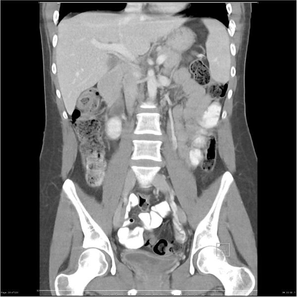 File:Bilateral ureteritis and cystitis (Radiopaedia 25340-25594 B 20).jpg