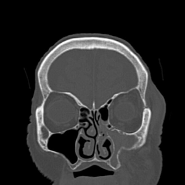 File:Biparietal osteodystrophy (Radiopaedia 46109-50463 Coronal bone window 26).jpg