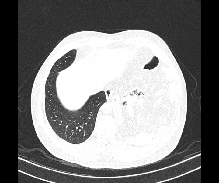 File:Bochdalek hernia - adult presentation (Radiopaedia 74897-85925 Axial lung window 37).jpg