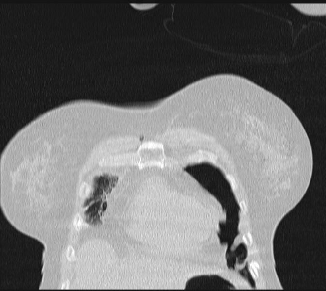 File:Boerhaave syndrome (Radiopaedia 45644-49799 Coronal lung window 11).jpg