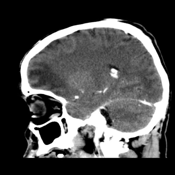 File:Brain metastases from lung cancer (Radiopaedia 24480-24781 C+ delayed 38).jpg