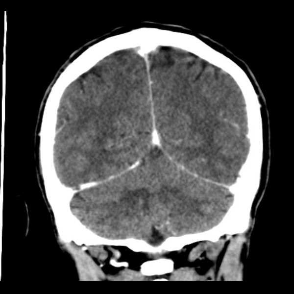 File:Brain metastases from lung cancer (Radiopaedia 24480-24781 Coronal C+ delayed 48).jpg