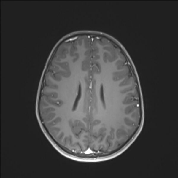 File:Brainstem glioma (Radiopaedia 70548-80674 Axial T1 C+ 104).jpg