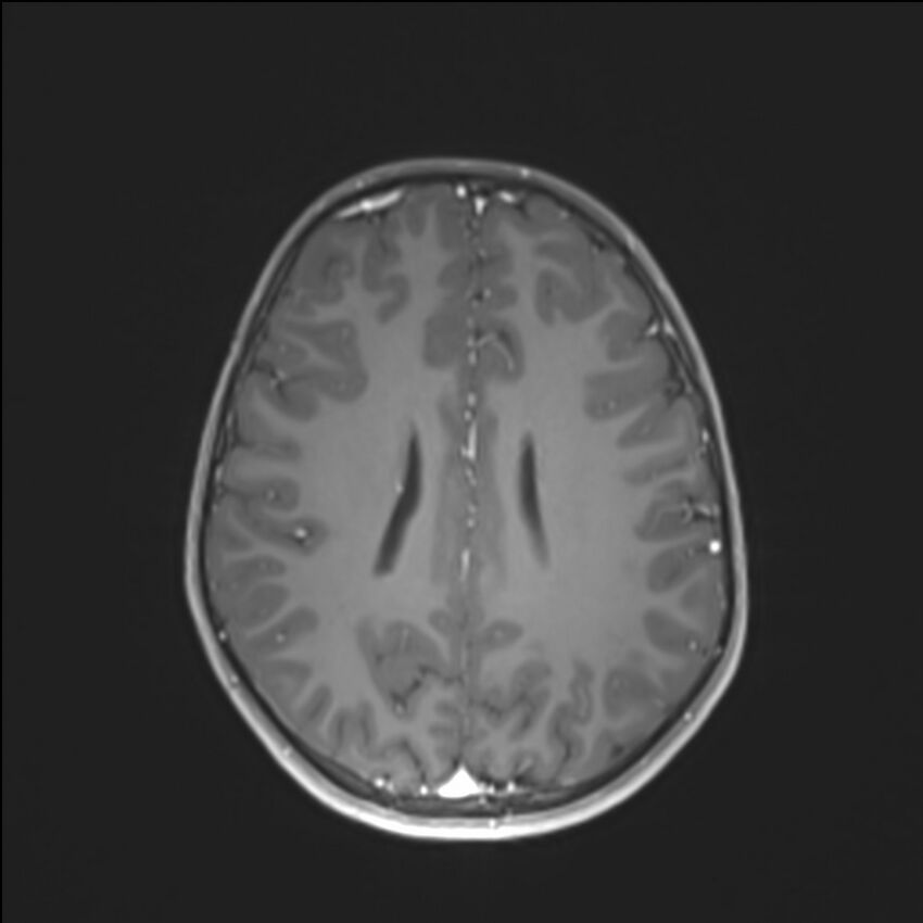 Brainstem glioma (Radiopaedia 70548-80674 Axial T1 C+ 104).jpg