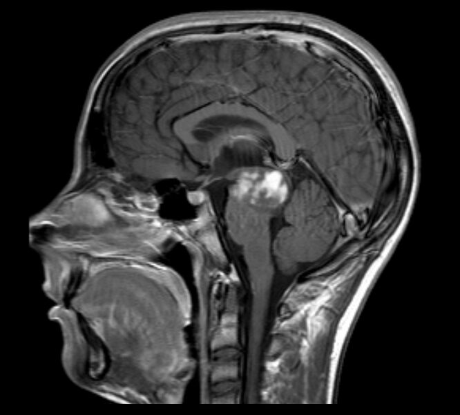File:Brainstem glioma - focal midbrain (Radiopaedia 6525-7840 Sagittal T1 C+ 1).jpg