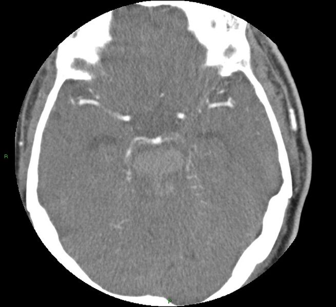 File:Brainstem hemorrhage (Radiopaedia 58794-66028 D 75).jpg