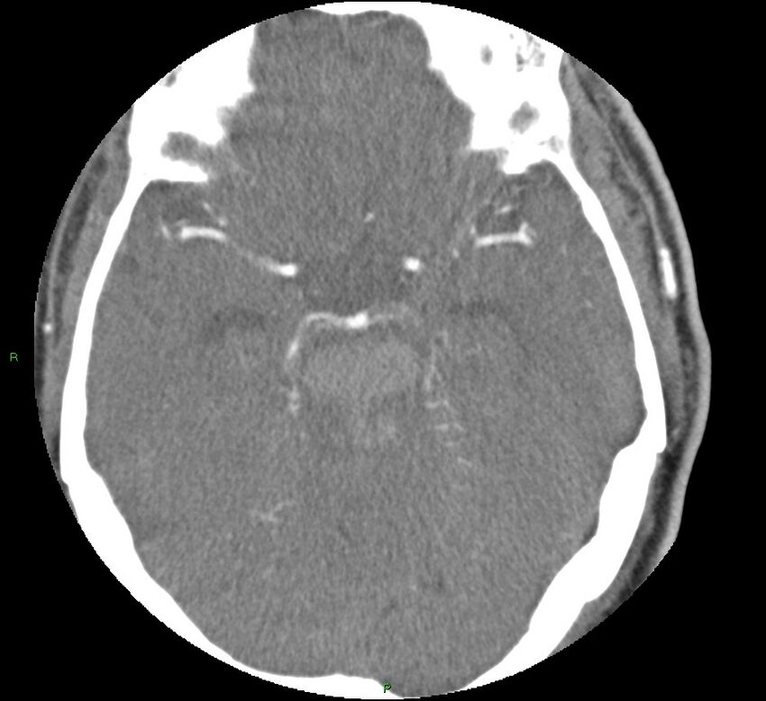 Brainstem hemorrhage (Radiopaedia 58794-66028 D 75).jpg