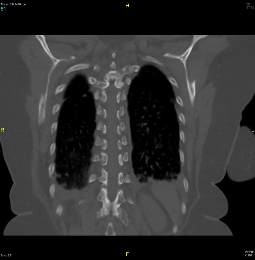 Breast primary with lung and bone metastases (Radiopaedia 40620-43228 bone window 61).jpg