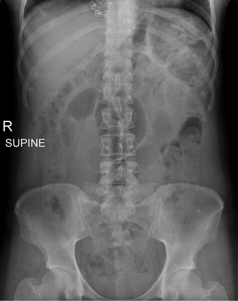 File:Broad ligament hernia (Radiopaedia 63260-71830 Frontal 1).jpg