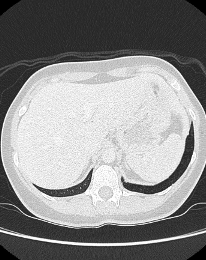 Bronchial atresia (Radiopaedia 50007-55297 Axial lung window 106).jpg