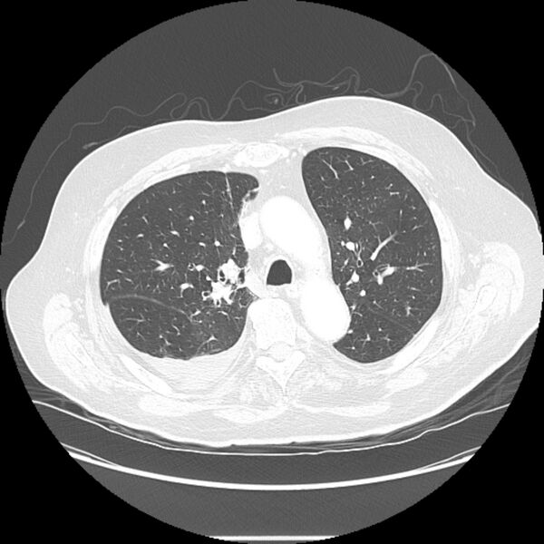 File:Bronchogenic adenocarcinoma and pulmonary embolism (Radiopaedia 9097-9806 Axial lung window 10).jpg