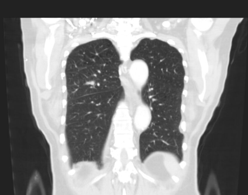 Bronchogenic carcinoma with lymphangitic spread (Radiopaedia 29002-29357 Coronal lung window 54).jpg
