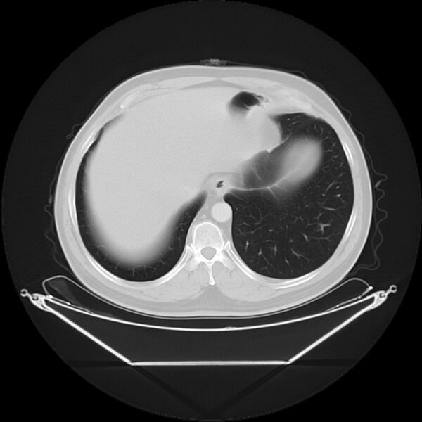 File:Bronchogenic carcinoma with upper lobe collapse (Radiopaedia 29297-29726 Axial lung window 28).jpg