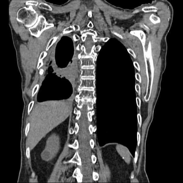 File:Bronchopleural fistula - postoperative complication (Radiopaedia 21020-20947 Coronal non-contrast 23).jpg