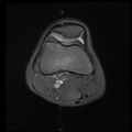 Bucket handle tear - lateral meniscus (Radiopaedia 72124-82634 Axial PD fat sat 3).jpg