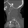 C1 anterior arch (plough) fracture - type 1 (Radiopaedia 76181-87720 Sagittal bone window 33).jpg