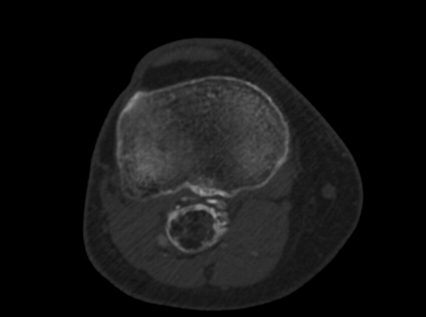 Calcified hematoma - popliteal fossa (Radiopaedia 63938-72763 C 46).jpg