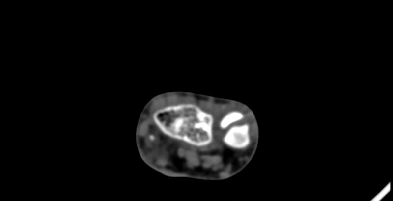 File:Calcifying aponeurotic fibroma (Radiopaedia 88423-105064 B 33).jpg