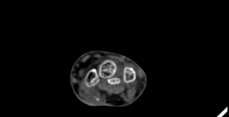 File:Calcifying aponeurotic fibroma (Radiopaedia 88423-105064 B 68).jpg