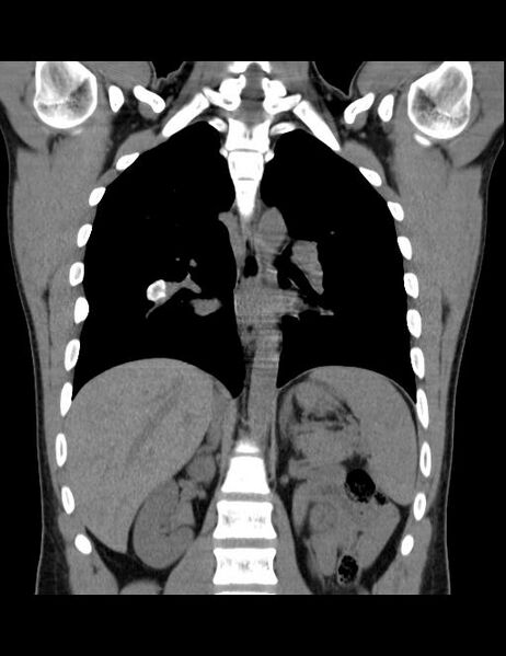 File:Calcifying pulmonary metastases (Radiopaedia 33359-34396 Coronal non-contrast 20).jpg