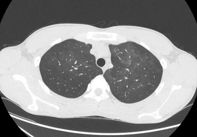 File:Cannabis-induced diffuse alveolar hemorrhage (Radiopaedia 89834-106946 Axial lung window 24).jpg