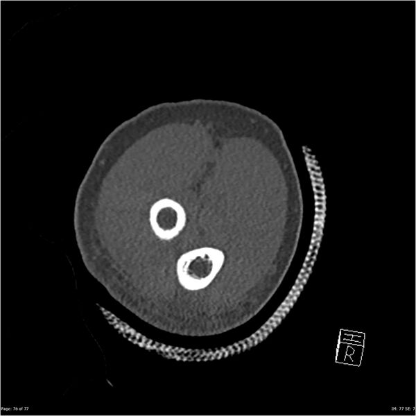 File:Capitellum fracture (Radiopaedia 23352-23426 Coronal bone window 76).jpg