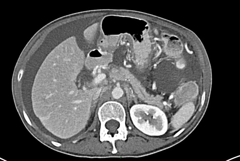 File:Carcinoid mesenteric tumor complicated by chylous ascites (Radiopaedia 76312-87953 A 21).jpg