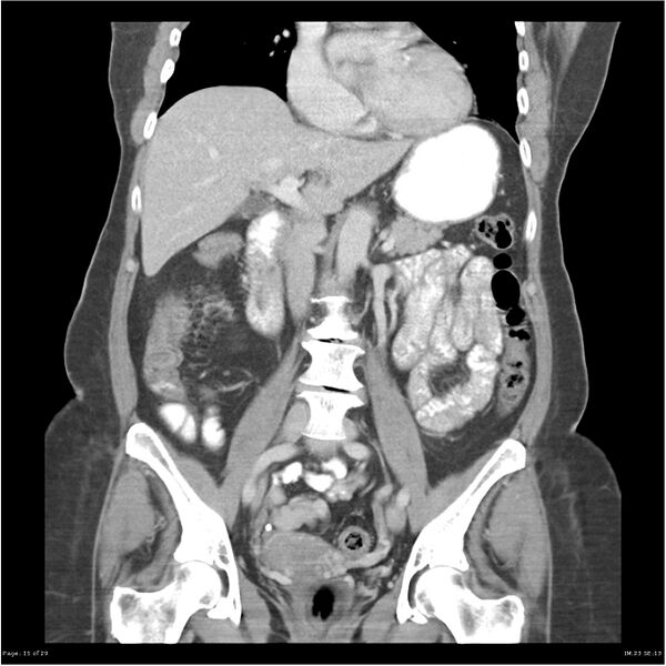 File:Carcinoid tumor of the ileum with metastasis to orbit (Radiopaedia 28165-28425 B 15).jpg