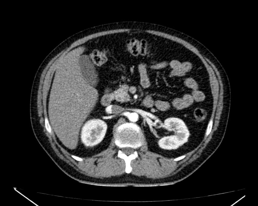 Carcinoid tumor with hepatic metastases (Radiopaedia 22651-22670 B 33).jpg
