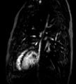 Cardiac hemangioma (Radiopaedia 16971-64065 Multiplanar 8).JPG