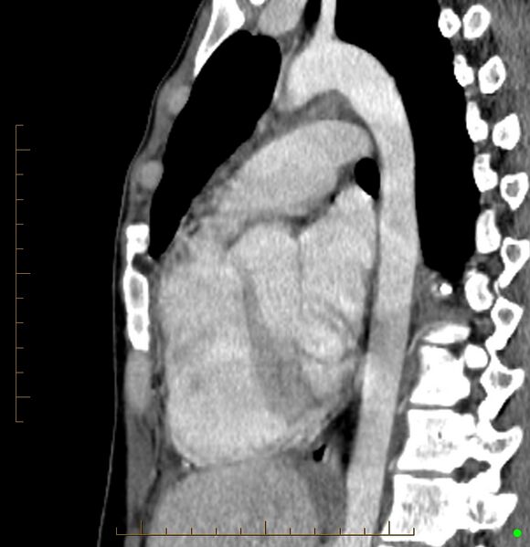 File:Cardiac paraganglioma (Radiopaedia 76345-88005 C 48).jpg