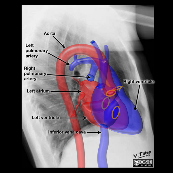 File:Cardiomediastinal anatomy on chest radiography (annotated images) (Radiopaedia 46331-50748 P 1).png