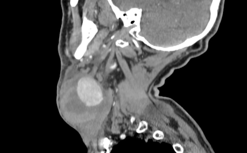Carotid artery pseudoaneurysm (Radiopaedia 84030-99259 E 39).jpg